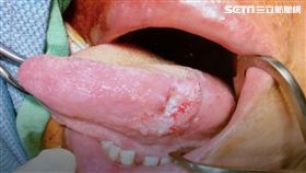 安南醫院,耳鼻喉科,劉金瑞,口腔癌,檳榔,口腔黏膜