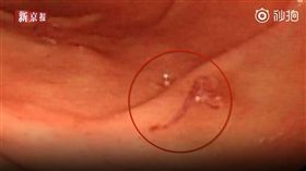 西安,肺癌,蛆蟲,偏方,癌症（新京報）