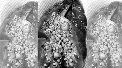 密集恐懼「腎」入！玉米粒結石醫嚇傻