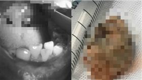 愛抽菸吃檳榔！男扁桃體長「乒乓球大」結石　張嘴還有大便味（圖／翻攝自梨視頻）