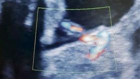 孕婦,胚胎,雙胞胎,異物,胎盤,懷孕,分裂,細胞,胎中胎,哥倫比亞　圖／翻攝自推特　