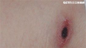 恙蟲病叮咬處呈現無痛性的焦痂樣。（圖／台北市衛生局提供）