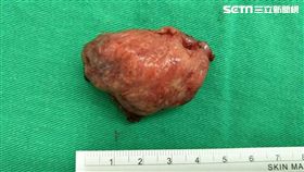 口腔癌,腫瘤,衛福部,彰化醫院,耳鼻喉科,許嘉方,吃檳榔
圖／翻攝自衛福部彰化醫院官網、臉書