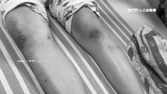 女童全身傷喪命！檢今將解剖釐清死因
