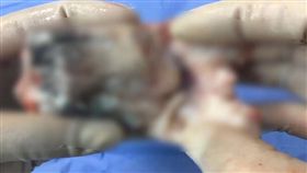 中國大陸男嬰「懷有寄生胎」。（圖／翻攝自看看新聞）