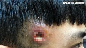 男友熬夜長出致命疔！太陽穴遭開洞如「遭子彈穿孔」(圖/網友提供授權)
