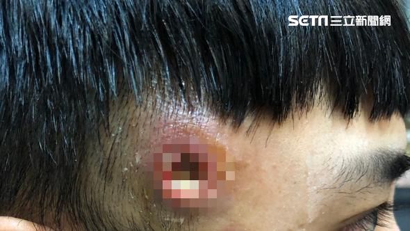 男友長出致命疔！太陽穴如遭子彈穿孔