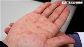 梅毒,性病(圖/亞洲大學附屬醫院提供)