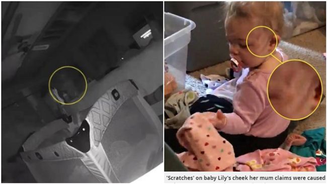 「透明男」閃過！1歲女兒臉留3瘀痕