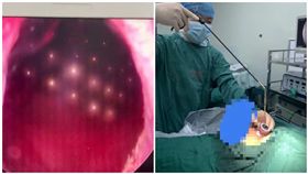 男童塞70顆磁珠進下體　醫手術幫「拉出來」（圖／翻攝自微博）