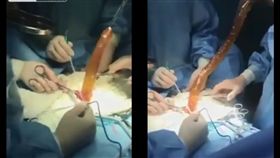 女子腹痛就醫，醫師手術夾出2公尺假陽具。（圖／翻攝自LiveLeak）