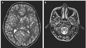 18歲青年癲癇送醫　腦內竟住滿「寄生蟲」不幸過世。（圖／擷取自《新英格蘭醫學雜誌》官網）