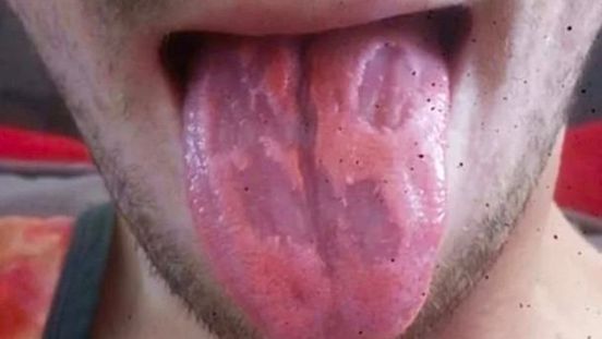 每天6罐能量飲　男長恐怖「壁癌舌」
