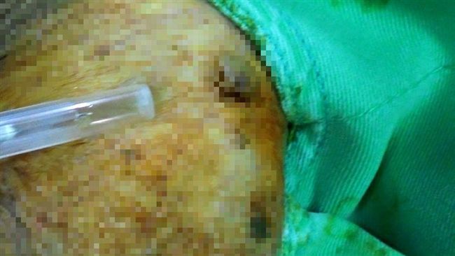新北市一間護理之家遭家屬質疑爆發俗稱「菜花」的尖銳濕疣群聚感染。（示意圖／資料照）