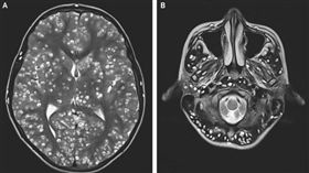 癲癇發作！18歲男寄生蟲遍布大腦…2週後亡(圖/《新英格蘭醫學雜誌》)