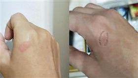 屁孩一口咬！護理師嫩手烙齒痕 家長反應扯翻（圖／爆怨公社）