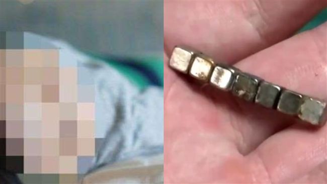7磁珠隔腸緊吸…童誤吞釀嚴重腸穿孔