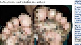 沙蚤病,黑頭膿包,光腳,巴西　（圖／翻攝自每日郵報）