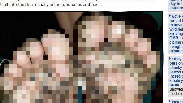 女童光腳逛豬圈！腳底長駭人黑頭膿包