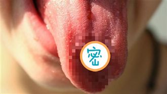 口腔破小洞以為感冒！她竟罹口腔癌第三期