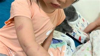 台南又傳虐童！繼父打罰　女童全身傷