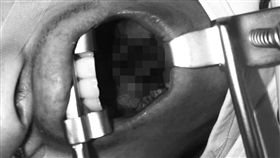 扁桃腺,中國陝西,手術　（圖／翻攝自搜狐）