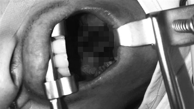 男喉嚨超卡狂咳！竟把扁桃腺咳出來