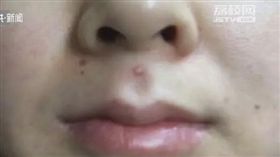 女擠人中痘痘引嚴重感染送醫險喪命。（圖／翻攝江蘇公共新聞）