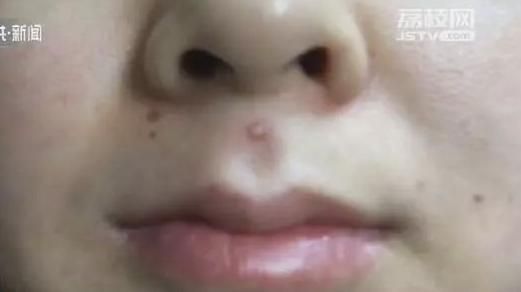 女擠危險三角區痘痘　高燒失禁險喪命