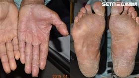 成大醫院,皮膚部,陳郁蓁,皮癬菌感染,香港腳,兩腳一手症候群
圖／翻攝自成大醫院臉書