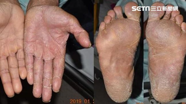 總用手抓香港腳婦人罹 兩腳一手症候群 生活 三立新聞網setn Com