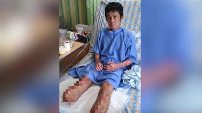 生吃豬肉太恐怖！他截去雙腿才保命