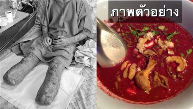 男嚐泰國名菜染病毒　雙腳截肢險喪命