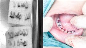 ４歲童的牙全爛掉 牙醫都嚇到(圖/中國報)