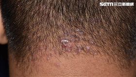 成大醫院,皮膚部,王羽安,皮膚,頸部蟹足腫性痤瘡,頭皮,長痘痘
圖／翻攝自成大醫院臉書