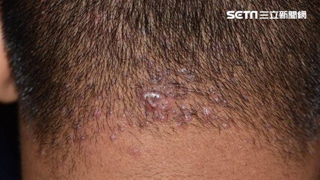 32歲男頭皮長痘痘　結果頭髮也掉…