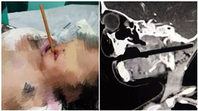 邊吃邊玩！3歲童「禍從口入」 筷子插入顱內10公分(圖/翻攝自微博)