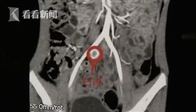 中國,廣東,腎　（圖／翻攝自看看新聞）