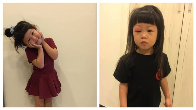 女兒睡覺被蚊爽叮　醒來右眼腫成大福