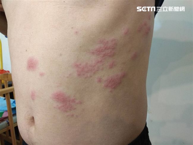 醫師表示，心血管疾病患者為帶狀疱疹高風險族群，引發心肌梗塞、中風等風險升高。（示意圖／資料照）