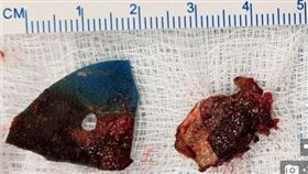 女孩鼻涕流不停，照片子驚見「蹼狀物被血肉覆蓋」取出飆惡臭！（圖／翻攝自每日郵報）