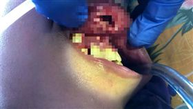 牙醫,少女,馬來西亞,蒼蠅,蛆蟲,巢穴
翻攝自Mohd Khairul Izwan的臉書