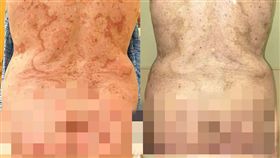 皮膚,癌症,環狀紅斑,美國,肛門癌,病徵,紅斑,皮疹, 圖／翻攝自推特　