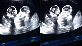 肚內雙胞胎姊妹！小手「互毆」扭打　超音波可愛畫面曝光
（圖／翻攝自梨視頻）
