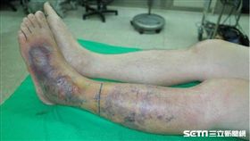 農夫遭黑腹眼鏡蛇咬／台中榮總提供