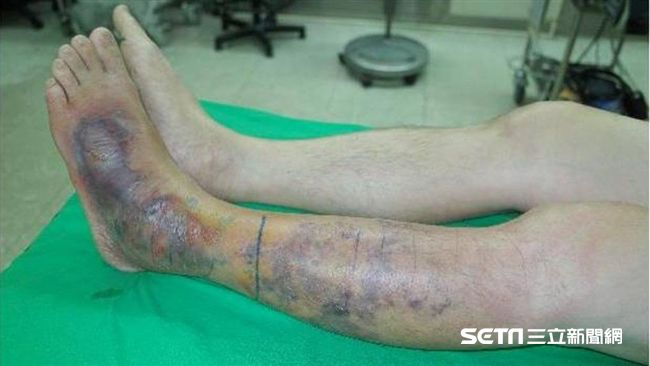 男遭毒蛇咬打死牠泡酒喝　下場險送命