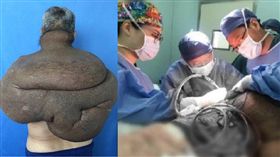 如鐘樓怪人！男巨大腫瘤背30年壓血管　動員100醫手術（圖／翻攝自微博@許牧楸）