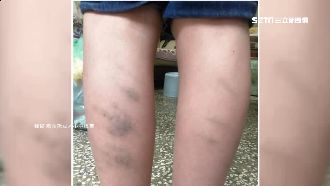 家長控訴補習班體罰　學童小腿全瘀青
