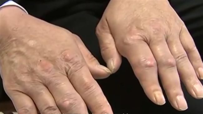 飲料當水喝！男滿手「怪石」嚇壞醫師