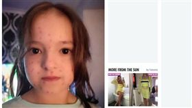 水痘，英國女童史庫利（Lily Schooley）。(圖/翻攝自太陽報)